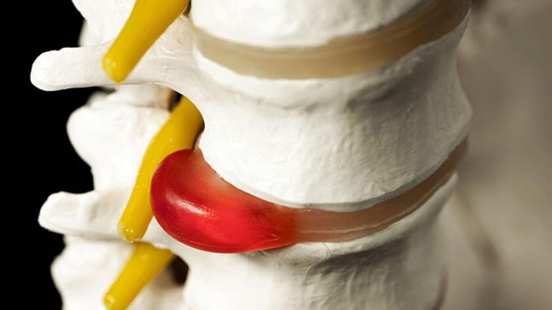 فیزیوتراپی دیسک کمر 1 فیزیوتراپی دیسک