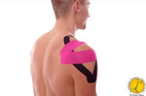 کینزیوتیپینگ