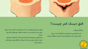 فیزیوتراپی دیسک کمر + روش های تشخیص و درمان 1 فتق دیسک کمر چیست ؟