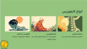 کایفوزیس (قوزپشتی) چیست؟ + 4 روش درمان آن 4 انواع کایفوزیس