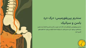 سندرم پیریفورمیس چیست؟ - (علائم و روش های درمان) 1 سندرم پیریفورمیس