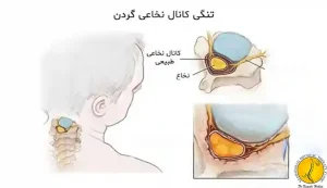 تنگی کانال نخاعی گردنی