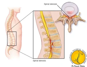 تنگی کانال نخاعی مرکزی