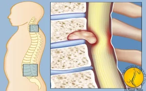 عوامل تنگی کانال نخاعی