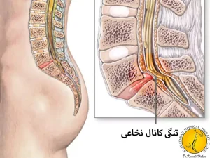 تنگی کانال نخاعی کمری