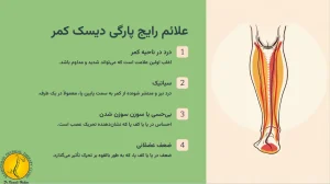 علائم رایج پارگی دیسک کمر