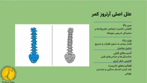 علت ارتروز کمر