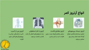 انواع ارتروز کمر