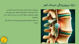 درمان دیسک کمر با روش مکنزی 2 درک بیرون زدگی دیسک کمر