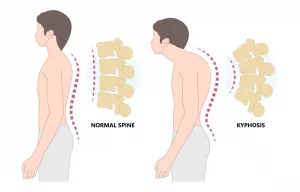 کیفوز توراسیک