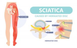 تفاوت سیاتیک و دیسک کمر