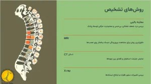 تشخیص پاره شدن دیسک کمر