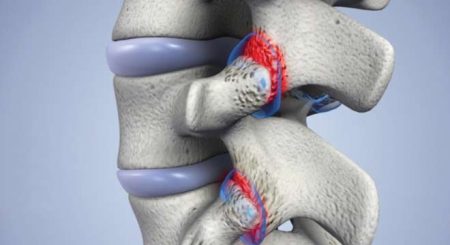 سندروم مفصل فاست