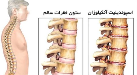 اسپوندیلیت آنکیلوزان