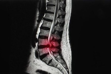 درمان تنگی کانال نخاع با فیزیوتراپی