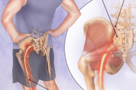 درد عصب سیاتیک