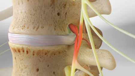 عوارض دیسک کمر