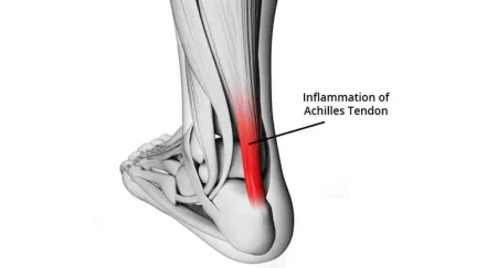التهاب تاندون آشیل