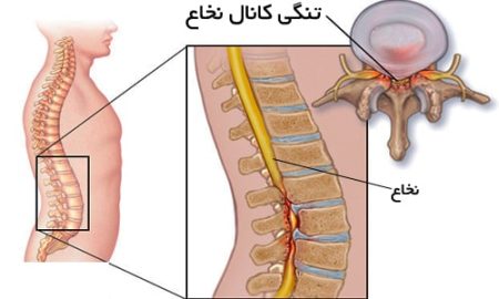 فیزیوتراپی تنگی کانال نخاعی