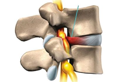 درمان دیسک کمر